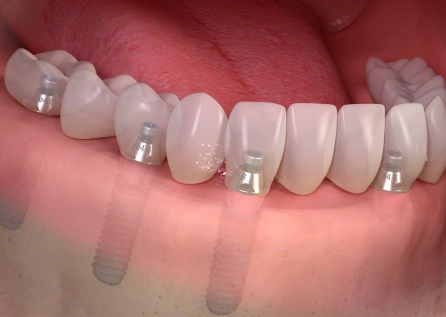 6 steps to hire a specialist for dental implant