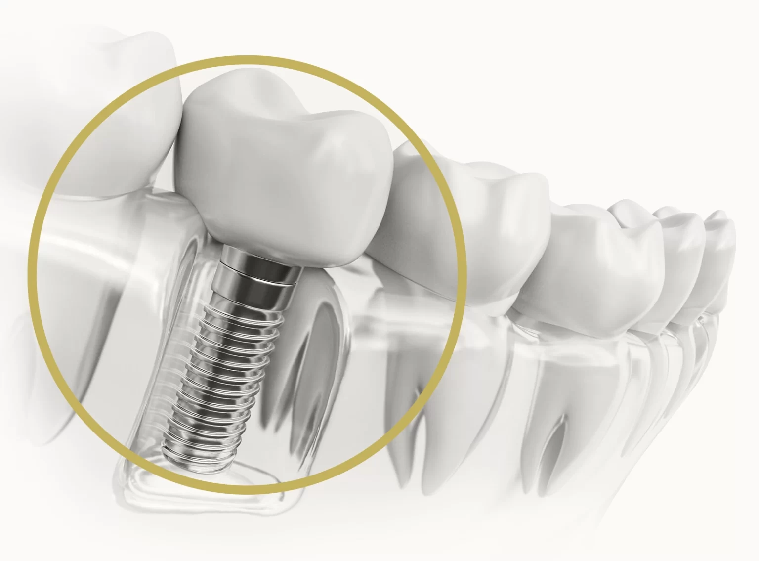Dental Implants Aftercare – Essential Tips For Long-Term Success